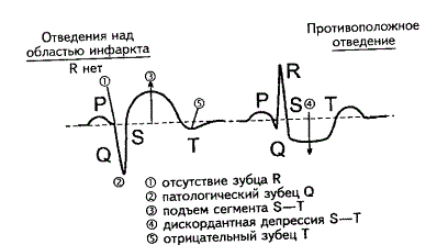 Основные признаки инфаркта миокарда