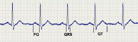 комплекс QRS