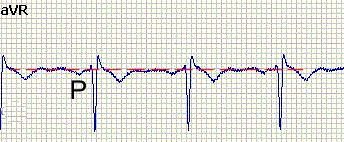 Отрицательный зубец P в aVR отведении 