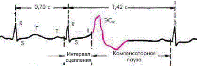 Пример экстрасистолии