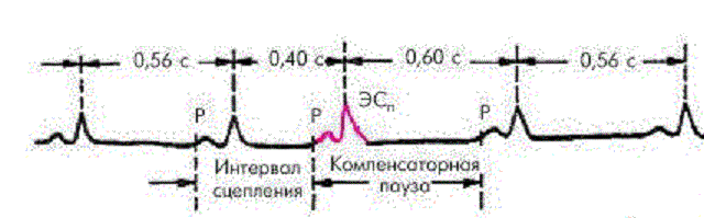 Пример экстрасистолии