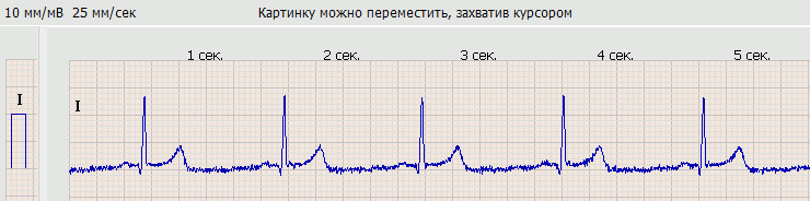 ЭКГ отведение 1